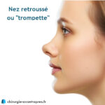 Rhinoplastie Nez En Trompette Retrouss