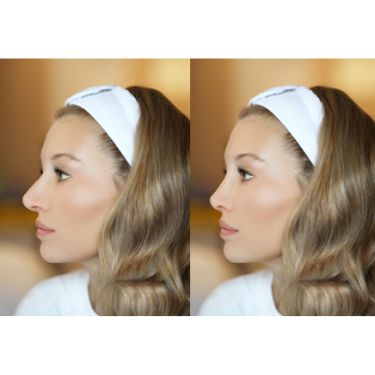 Rhinoplastie av ap