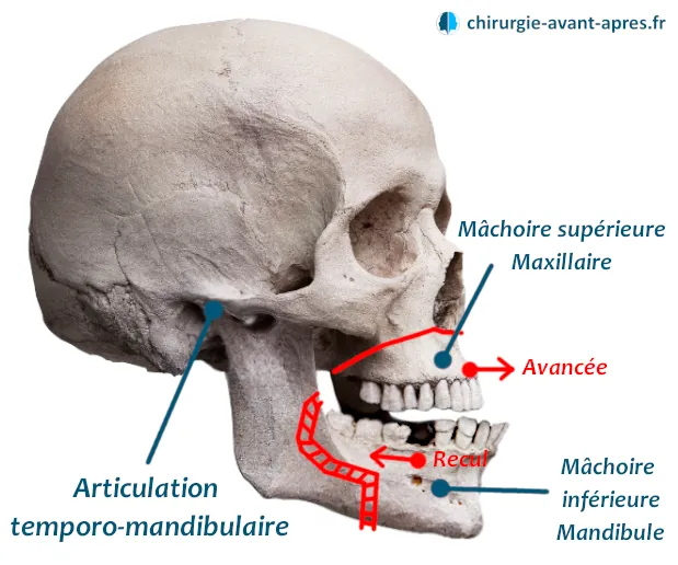 anatomie crane chirurgie machoire en avant prognathie classe III le fort bimaxillaire