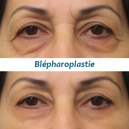 Blépharoplastie