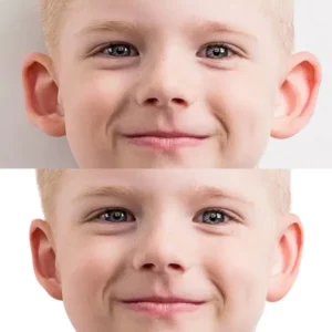 Enfant avec les oreilles décollées otoplastie