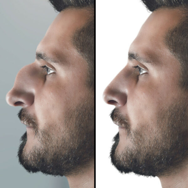 Homme avec une bosse sur le nez - Rhinoplastie AVANT APRES