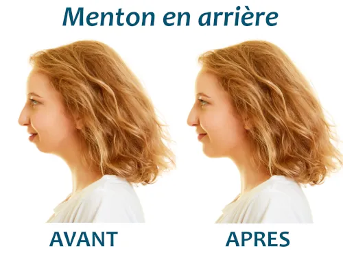 menton en arriere fuyant genioplastie apres avant