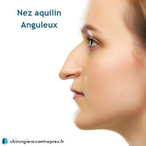 Nez aquilin rhinoplastie