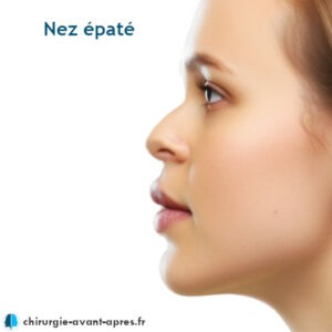 Nez épaté écrasé aplati rhinoplastie