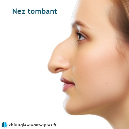 Nez tombant rhinoplastie