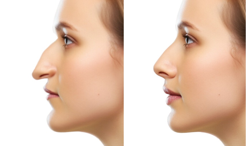 Rhinoplastie nez crochu aquilin