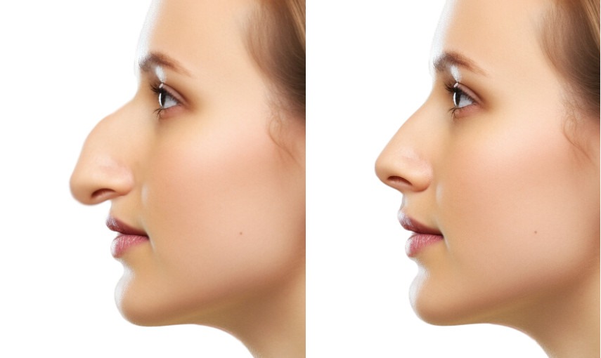 Rhinoplastie nez tombant