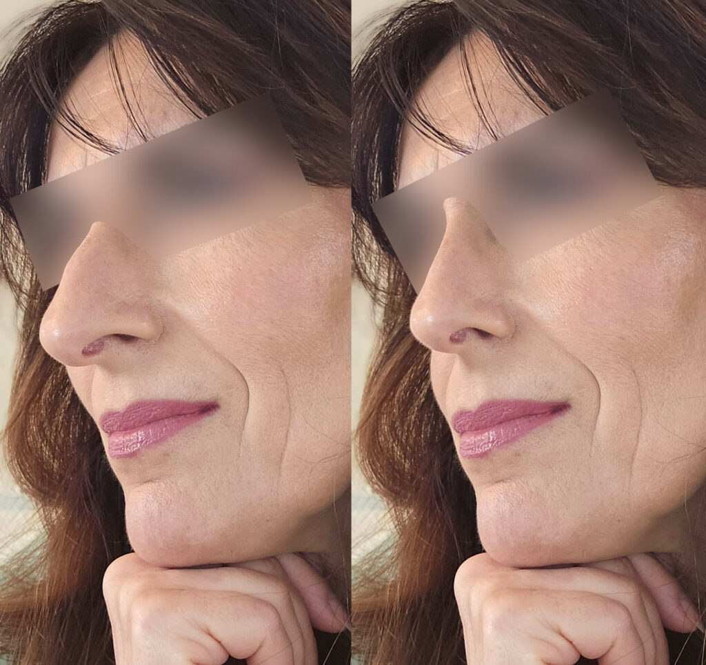 rhinoplastie avant apres chirurgie du nez