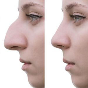 rhinoplastie bosse nez femme 2