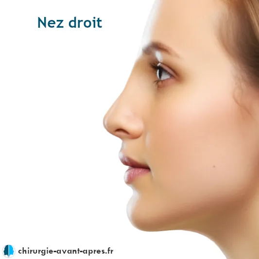 Nez droit rhinoplastie