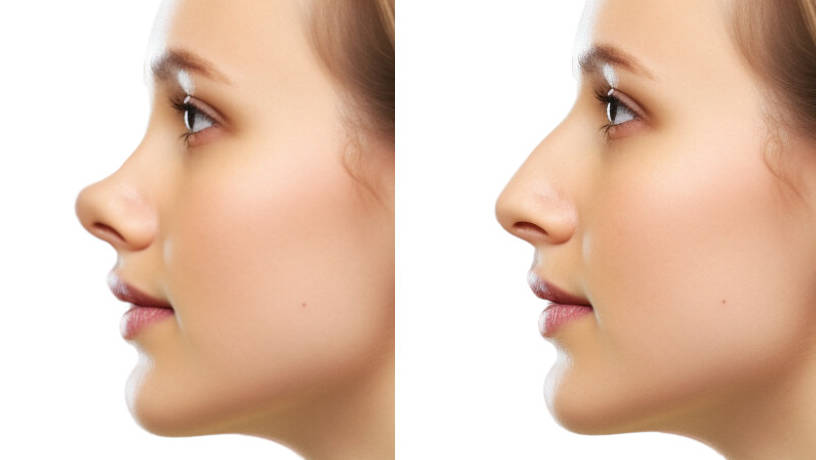 Rhinoplastie nez en trompette avant après