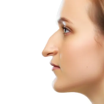 nez-crochu-rhinoplastie