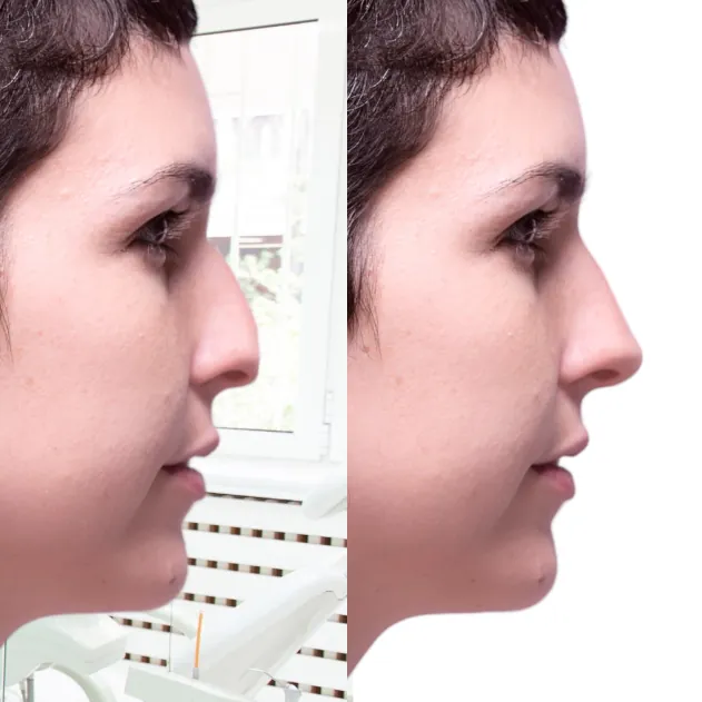 injections acide hyaluronique rhinoplastie medicale