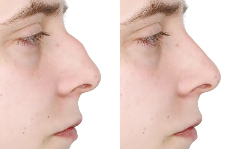 légère bosse sur le nez homme rhinoplastie