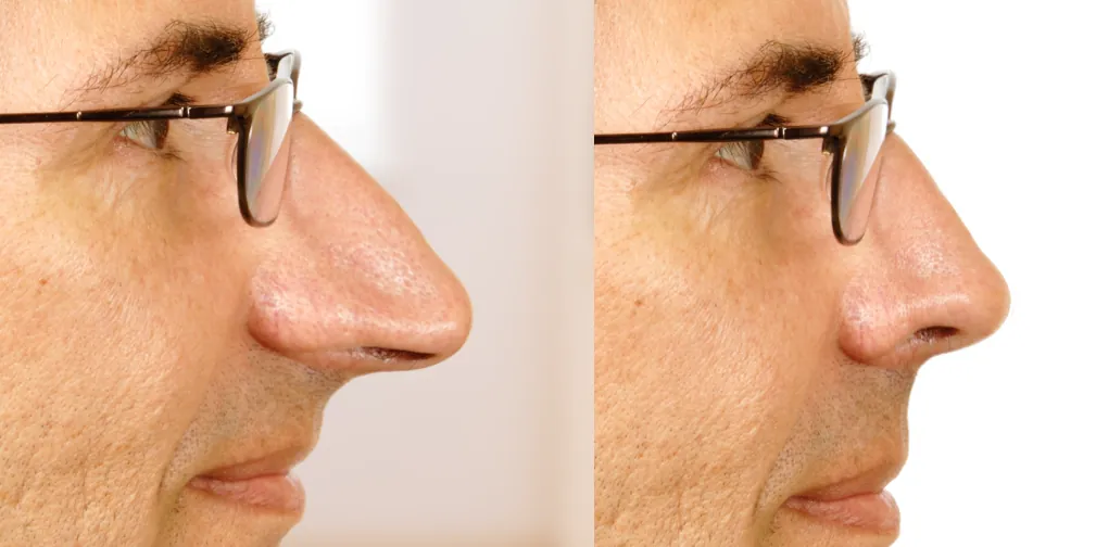 Rhinoplastie nez long avant après