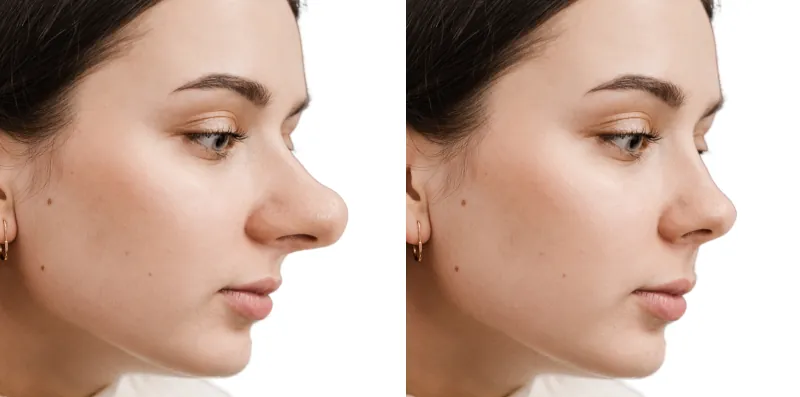 long nez femme rhinoplastie