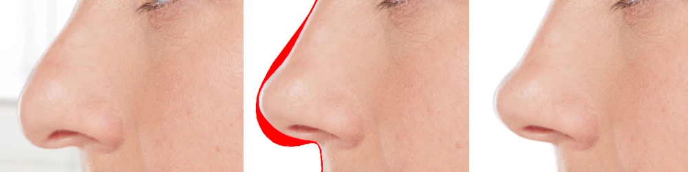 nez bec de corbin rhinoplastie secondaire ratée