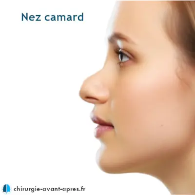 Femme vue de profil avec un nez camard