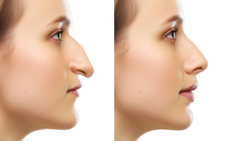 rhinoplastie avant apres