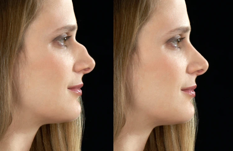 Femme avec un nez grec résultat rhinoplastie