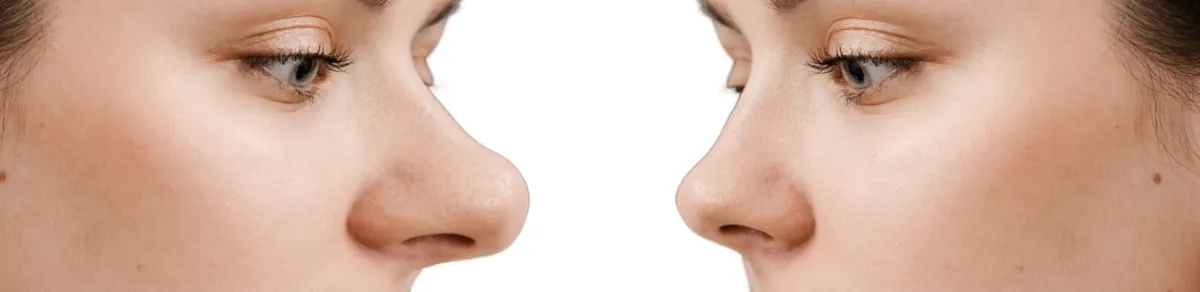 rhinoplastie femme