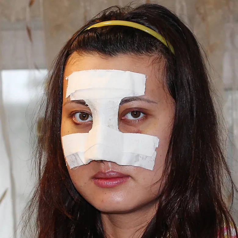 femme avec le nez plâtré suite à une rhinoplastie