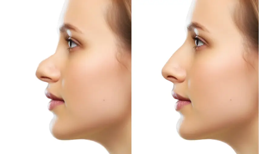 Illustration avant/après d'une rhinoplastie du nez camard sur une femme