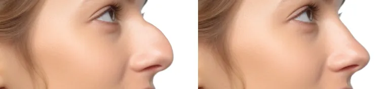 rhinoplastie par ultrasons avant apres