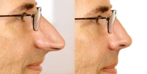 rhinoplastie par ultrasons piezoelectricite