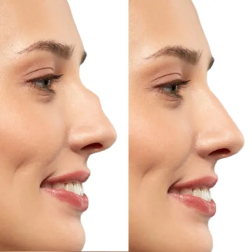 simulation rhinoplastie