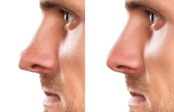 avant apres rhinoplastie nez carmard