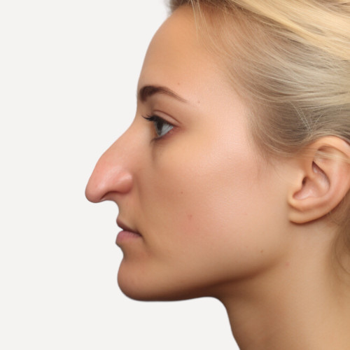 nez crochu femme rhinoplastie