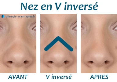 nez en v inversé rhinoplastie ratée