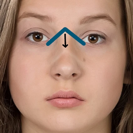 nez v inversé rhinoplastie femme