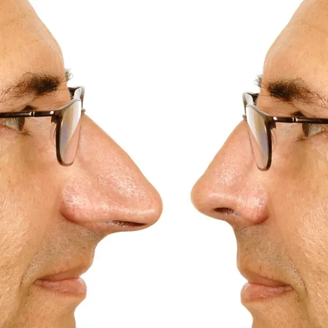 photos avant apres rhinoplastie