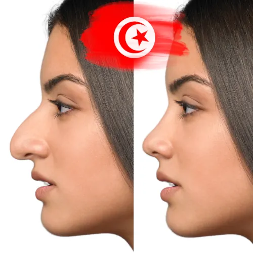 prix rhinoplastie en tunisie