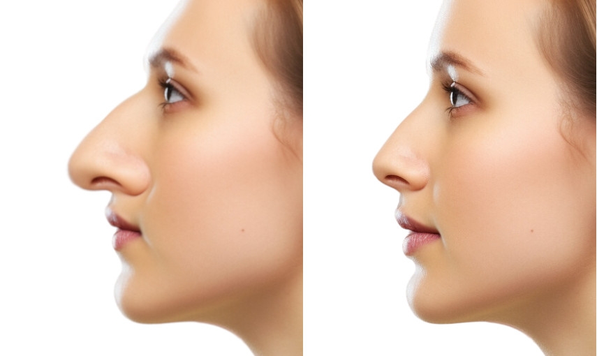 rhinoplastie AVANT APRES gros nez