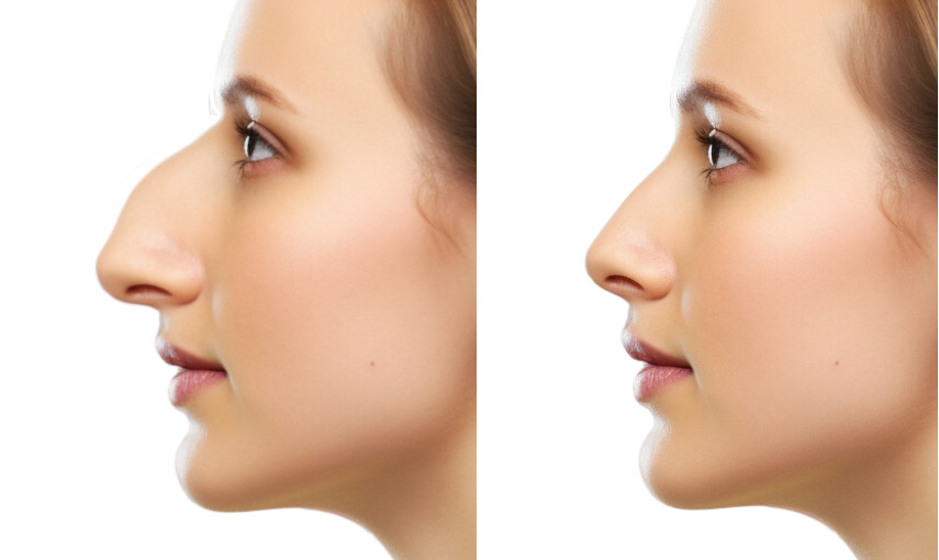 rhinoplastie AVANT APRES nez bossu