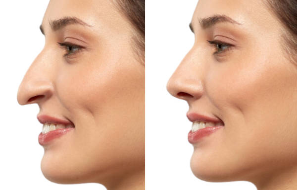 rhinoplastie avant apres nez crochu femme