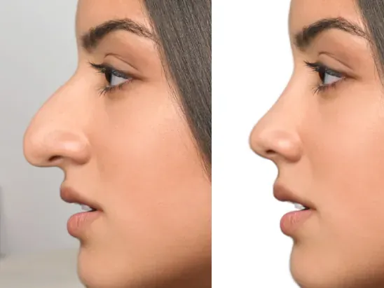 rhinoplastie avant apres tunisie