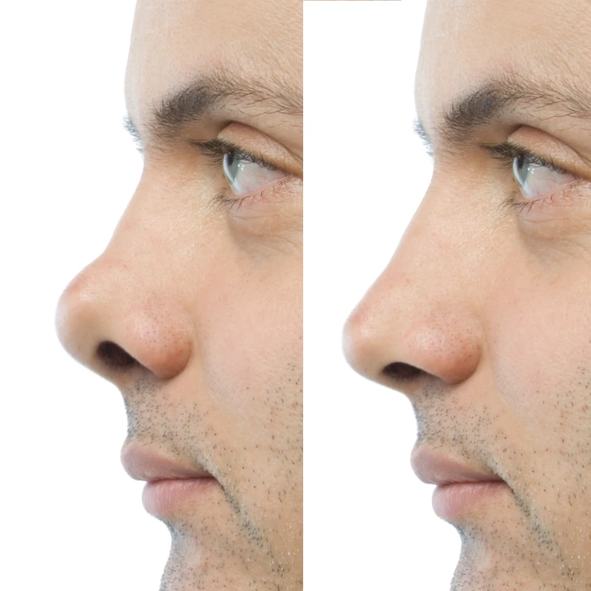 rhinoplastie secondaire homme