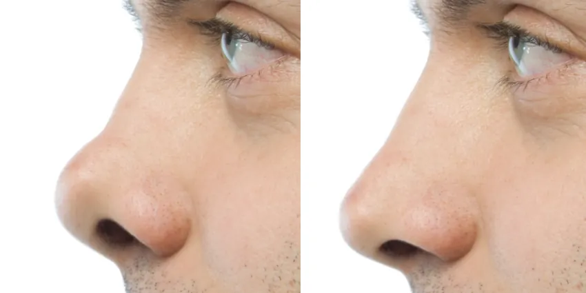 rhinoplastie secondaire nez homme