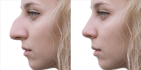 rhinoplastie bosse nez