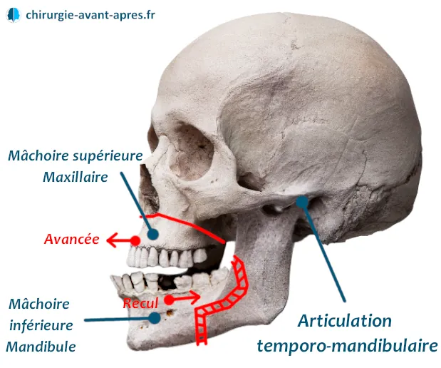 chirurgie menton en avant