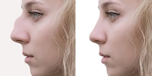 nose rhinoplasty