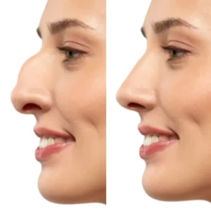 rhinoplasty nose surgery simulation woman