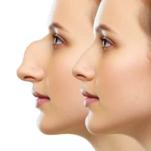 Rhinoplastie simulation avant apres